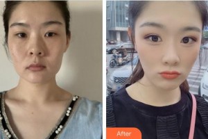 安徽醫(yī)科大學第二附屬醫(yī)院整形美容中心謝娟整形價格表附面部年輕化案例展示