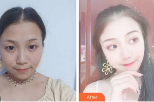 安徽醫(yī)科大學第二附屬醫(yī)院整形美容中心丁浩整形價格表附埋線提升案例展示