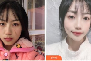 安徽醫(yī)科大學第一附屬醫(yī)院整形美容中心趙宇整形價格表附祛疤案例展示