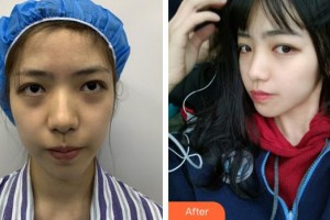 安徽立新醫(yī)學美容門診部江菊整形價格表附面部埋線提升案例展示