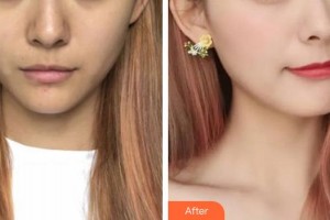 安徽韓美整形美容醫(yī)院吳鳳芝整形價格表附超激光美膚案例展示