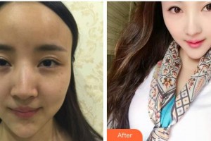 安徽省立醫(yī)院整形燒傷外科杜曉楊整形價格表附鼻部案例展示