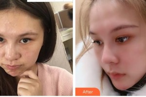 安徽省立醫(yī)院整形燒傷外科趙李平整形價格表附網(wǎng)紅小翹鼻案例展示