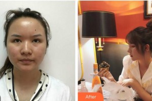 安徽醫(yī)科大學第一附屬醫(yī)院整形美容中心高學宏整形價格表附鼻部手術日記案例展示