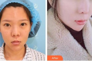 安徽醫(yī)科大學第一附屬醫(yī)院整形美容中心張林整形價格表附網(wǎng)紅鼻部手術案例展示