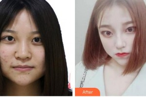 安徽醫(yī)科大學第一附屬醫(yī)院整形美容中心朱飛整形價格表附鼻部手術案例展示