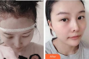 安徽長征微創(chuàng)外科醫(yī)院整形美容科邸偉整形價格表附發(fā)際線案例展示