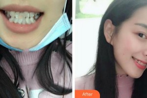 安徽韓美整形美容醫(yī)院相道舉整形價格表附牙齒陶瓷矯正案例展示