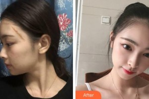 武警安徽總隊醫(yī)院皮膚美容科陳政利整形價格表附疤痕案例展示