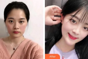 安徽維納斯醫(yī)院整形外科陳棟整形價格表附埋線提升案例展示