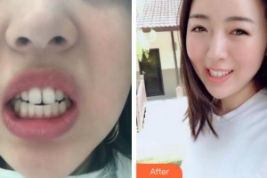 安徽天鵝湖口腔醫(yī)院丁杉整形價格表附牙齒矯正案例展示