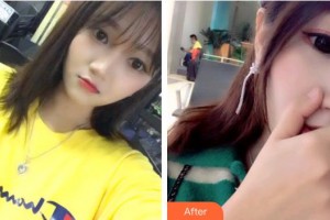 安徽天鵝湖口腔醫(yī)院彭國新整形價格表附牙綜合案例展示