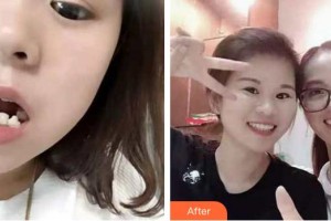 安徽天鵝湖口腔醫(yī)院婁雙岳整形價格表附牙齒陶瓷矯正案例展示