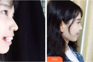 安徽醫(yī)科大學口腔醫(yī)學院何家才整形價格表附齙牙小仙女案例展示