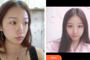 安徽醫(yī)科大學(xué)附屬阜陽醫(yī)院燒傷整形創(chuàng)面外科白永強(qiáng)整形價(jià)格表附祛疤案例展示