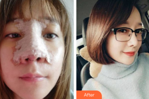 廣州藝美醫(yī)療美容門診部李闖整形價格表附鼻部手術(shù)案例展示