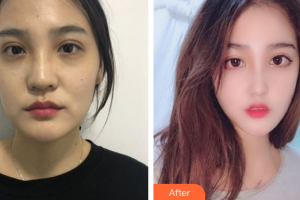 廣州國姿醫(yī)療美容整形醫(yī)院曾德浩整形價格表附鼻部手術(shù)案例展示