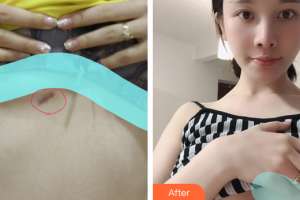 廣州博研醫(yī)療美容門診部劉鳳巖整形價格表附激光祛疤痕案例展示