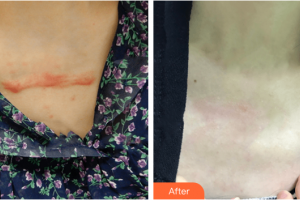 廣州凱美達(dá)整形美容醫(yī)院曾芬整形價格表附微創(chuàng)疤痕修復(fù)案例展示