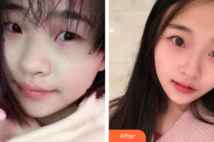 廣州美詩沁醫(yī)療美容門診部汪生整形價格表附眼部手術(shù)案例展示