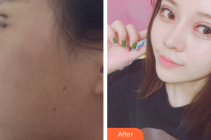 廣州軍區(qū)總醫(yī)院全軍激光整形美容中心程飚整形價格表附雙眼皮案例展示