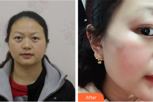 廣州博研醫(yī)療美容門診部田艷麗整形價格表附面部疤痕修復(fù)案例展示