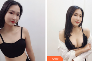 廣州塑妍醫(yī)療美容門診部黎明整形價格表附自體脂肪隆胸案例展示