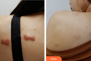 廣州鵬愛醫(yī)療美容門診部付曉焜整形價格表附微創(chuàng)疤痕修復(fù)案例展示