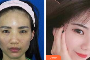 廣州洛萱醫(yī)療美容門診部彭章松整形價格表附自體脂肪全臉填充案例展示