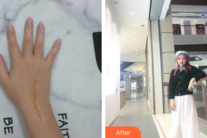 廣州醫(yī)科大學(xué)附屬第一醫(yī)院整形外科朱健整形價格表附增生疤痕案例展示