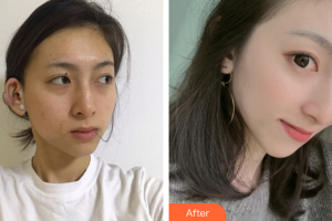 廣州中家醫(yī)家庭醫(yī)生醫(yī)學(xué)整形美容醫(yī)院于國中整形價格表附疤痕疙瘩案例展示