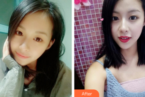 廣州慕美醫(yī)療美容醫(yī)院凌通整形價格表附精致雙眼皮案例展示