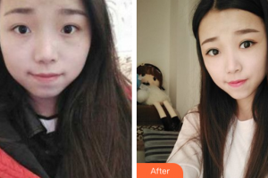 廣州懿美秀醫(yī)療美容門診部彭雷整形價格表附眼部手術(shù)案例展示