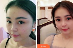 廣州美萊醫(yī)療美容醫(yī)院陳貴宗整形價格表附疤痕案例展示