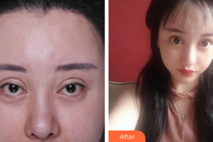 廣州醫(yī)科大學附屬第一醫(yī)院整形外科冀航整形價格表附失敗重瞼修復+上瞼下垂矯正案例展示