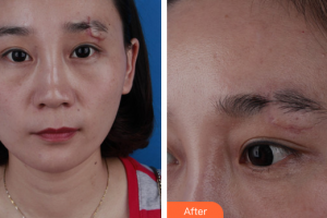 廣州海峽醫(yī)學整形美容醫(yī)院閆愛躍整形價格表附疤痕修復案例展示