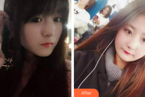 廣州德倫口腔門診部程武整形價(jià)格表附牙齒根管調(diào)節(jié)案例展示