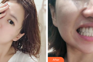 廣州市第十二人民醫(yī)院整形美容科陳家歡整形價(jià)格表附隱形托槽矯正案例展示