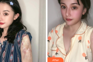 廣州醫(yī)科大學(xué)附屬第一醫(yī)院整形外科曹浩財(cái)整形價(jià)格表附燙傷疤痕案例展示