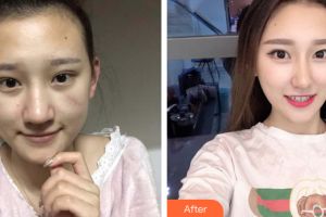 廣州名韓醫(yī)療美容醫(yī)院閆倫整形價(jià)格表附手術(shù)疤痕案例展示