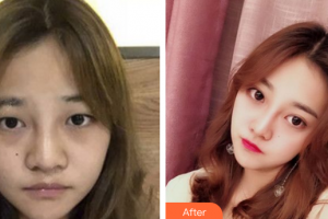 廣州韓佳人醫(yī)療美容醫(yī)院詹曉芳整形價(jià)格表附眼部手術(shù)案例展示