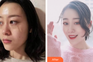 廣州膚康皮膚科醫(yī)院馬在墀整形價(jià)格表附凹陷疤痕案例展示