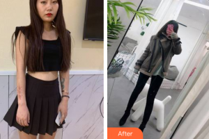 廣州醫(yī)科大學(xué)附屬第一醫(yī)院整形外科梁剛整形價(jià)格表附手術(shù)疤痕案例展示