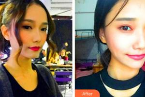 廣州壹加壹美容醫(yī)院姚文波整形價(jià)格表附熱瑪吉案例展示