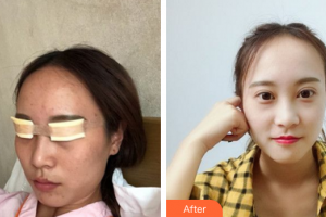 廣州美詩沁醫(yī)療美容門診部趙占國整形價(jià)格表附眼部手術(shù)案例展示