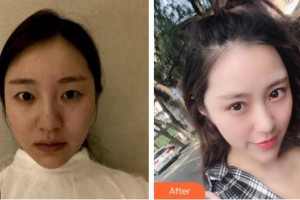 合肥伊爾醫(yī)療美容診所閆品行整形價格表附眼部綜合案例展示