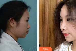 合肥凱美醫(yī)療美容醫(yī)院王文俊整形價格表附鼻部整形案例展示