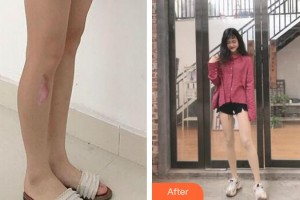 合肥恒美整形醫(yī)院周鐵政整形價格表附增生疤痕案例展示