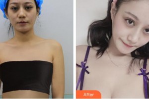 合肥恒美整形醫(yī)院孫楓整形價格表附假體隆胸棉花糖豐胸案例展示