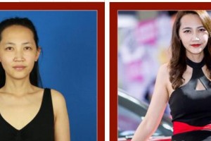 合肥恒美整形醫(yī)院錢毅整形價格表附假體隆胸案例展示